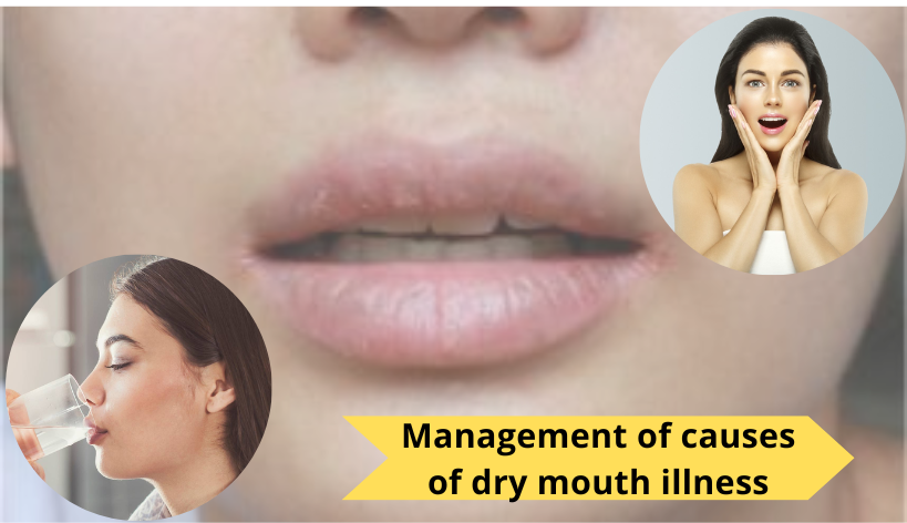Management-of-causes-of-dry-mouth-illness